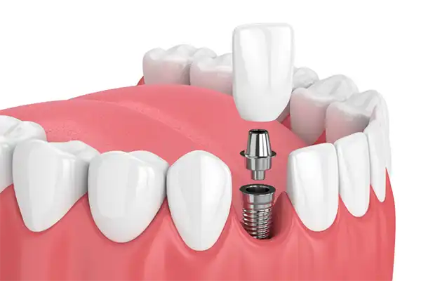 Dental Implants Central Coast